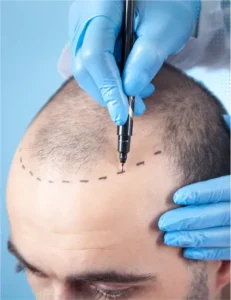 Scalp Micro